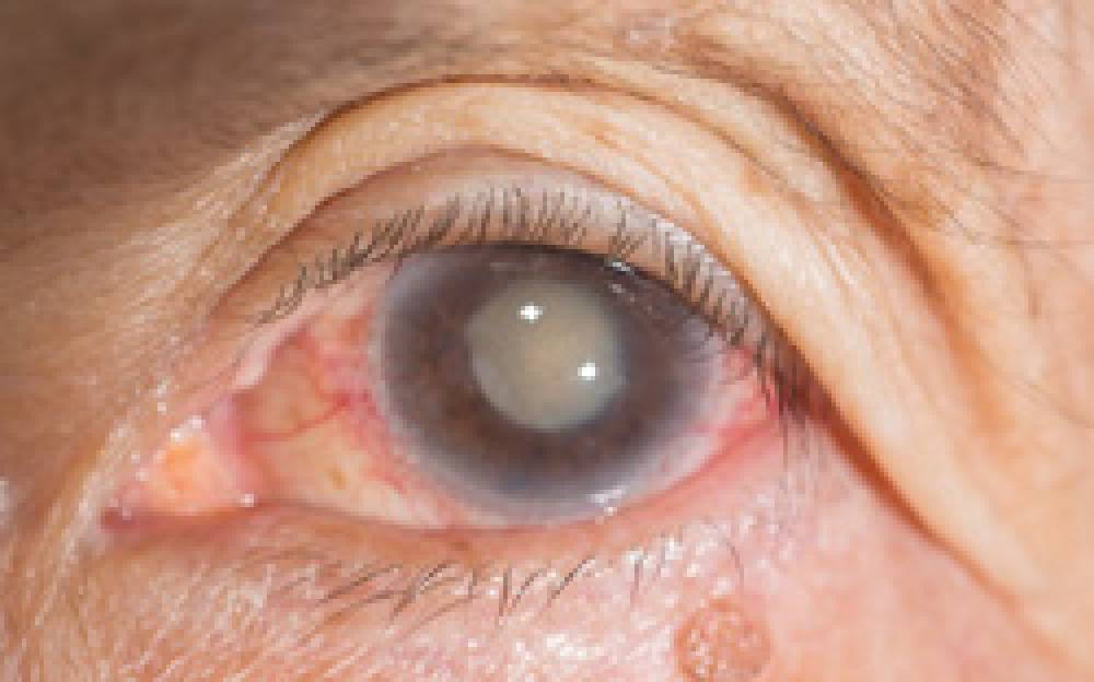 Cataract Surgery-Cataract specialist Wollongong - Wescentre.com.au